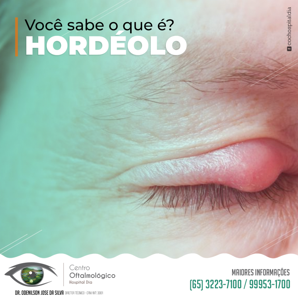 HORDÉOLO - Hospital de Olhos Curvelo