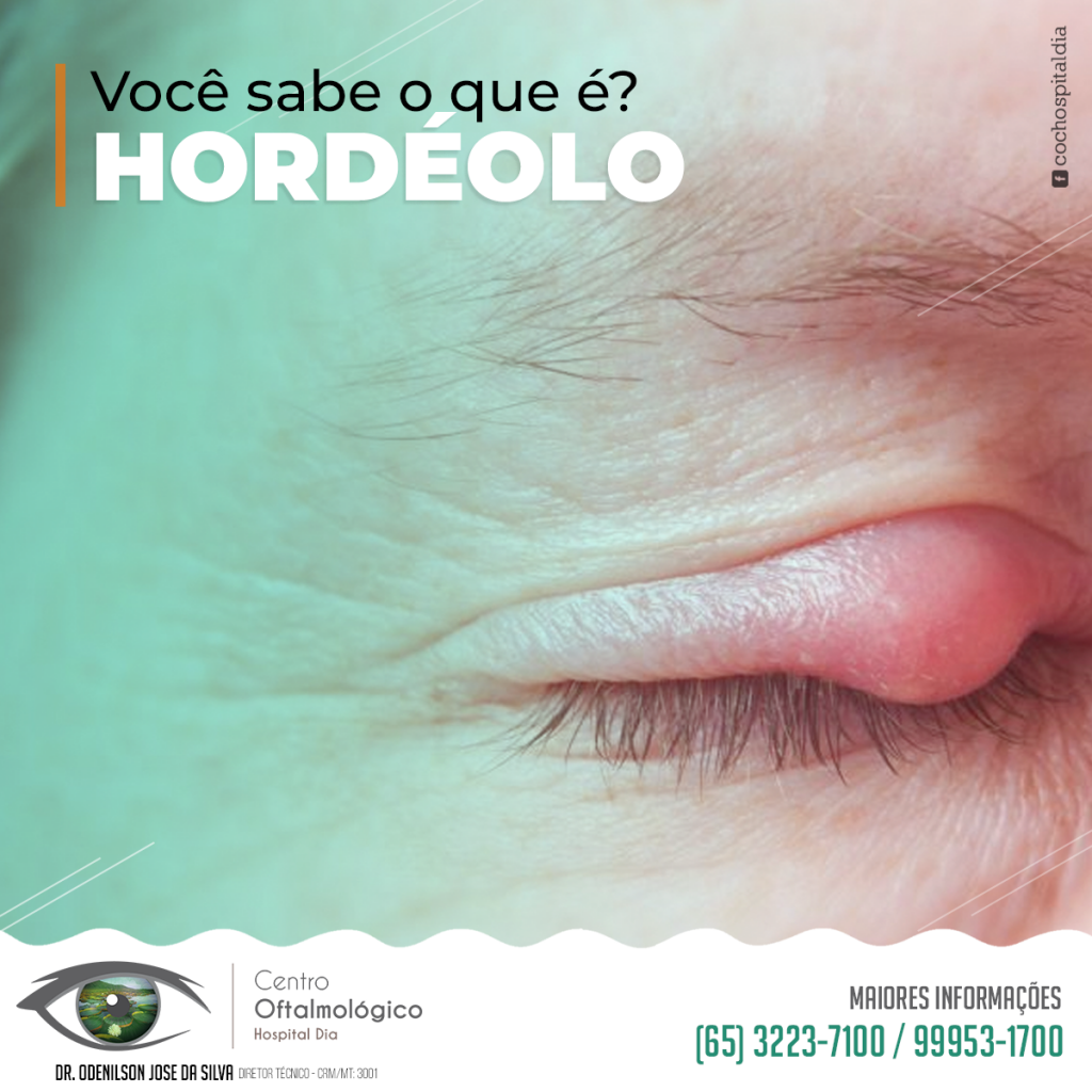 O que são hordéolo e calázio? - HOCO - Hospital de Olhos do Centro